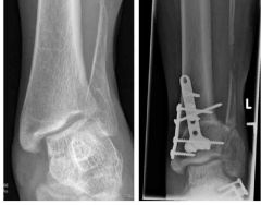 Hx:18 yo ambulatory F w/ spina bifida presents with a painful planovalgus L foot, failed tx w/ orthoses & heel-cord stretching. Ankle xray demonstrate that the distal tibia is tilted 15° into valgus relative to the long axis. Which of the followi...