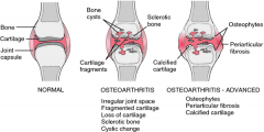 Osteoarthritis is a degenerative joint disease resulting from WEAR & TEAR.


 


Commonly affects large, weight bearing joints.