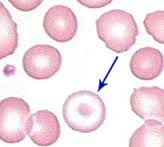 target cells or folded RBCs; usually due to excessive amount of EDTA; not diagnostically significant