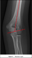 Intersect line drawn down humeral axis and a line drawn along growth plate of the lateral condyle
