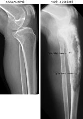 Describe paget disease of the bone.  How does it present?
