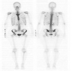 Tc 99m HDP/MDP
bone scan
bones, GU