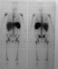 In 111 WBC scan
RES

*RES = reticuloendothelial system = liver, spleen, bone marrow