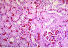 Sickle cell nephropathy

Glomeruli occluded by sickled red cells 
Extensive congestion and sickling in peritubular capillaries 

Sickle cell crisis = sickling in kidney, particularly vasa recta