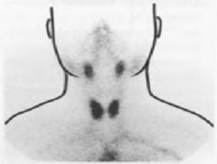 Tc 99m pertechnetate 
thyroid, salivary glands