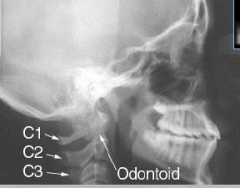 v = odontoid process 
 
arrow = cervical vertebra