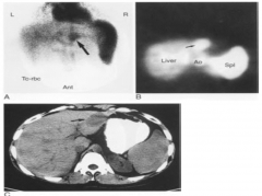 Tc 99m RBC hemangioma scan
RBCs localize to liver hemangiomas
