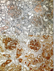 Can you tell what type of amyloid it is with congo red stain?

What is an immunoperoxidase stain used for (above)?
Problems?