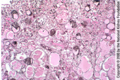 What is shown here? 
What is the most common lesion in HIV infection-related renal disease?