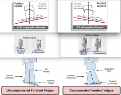Forefoot Varus = Calcaneal Valgus when compensated for

Forefoot Valgus = Calcaneal Varus when compensated for
