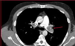 What is indicated on the CT?