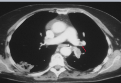 HRCT showing R. main pulmonary artery filling defect.