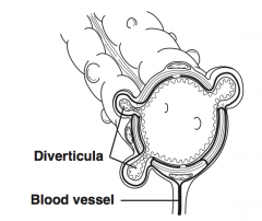 Condition in which diverticula can be found within the colon, especially the sigmoid; diverticula are actually false diverticula in that only mucosa and submucosa herniate through the bowel musculature


 


True diverticula involve all layers of...