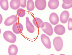 Teardrop cell due to myelofibrosis