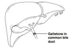 Gallstone in common bile duct