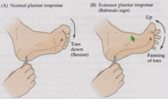 Normal plantar reflex - if stroke bottom of foot, toes flex down. 
Positive Babinski reflex - Big toe goes up and other toes fan down. Normal in babies but suppressed by upper motor neurons throughout most of life. Reliable sign of damage to cort...