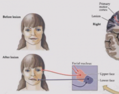 Preserved strength in upper face usually because facial nucleus for upper face gets input from both motor cortices.
Lower face gets facial droop because input from only contralateral cortex.