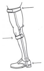 1. Commonly used for individuals with paraplegia (T9-T12 lesions)
2. Consists of shoe attachments with reinforced foot plates, BiCAAL ankle join set in slight DF, pretibial band, pawl knee locks with bail release, and single thigh bands