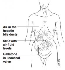 - Air in hepatic bile ducts
- SBO with air fluid levels
- Gallstone in ileocecal valve