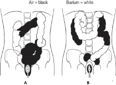In regards to the Air-Barium Distribution in the Large Intestine, what position is the patient in in both pictures?