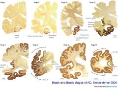 Which diease is associacted with:
cerebral atrophy
enlarged ventricles
-amyloid plaques and neurofibrillary tangles on a silver stained brain section)....

can you REMEMBER?!