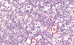 Lacunar Cells