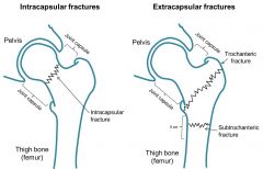 below the femoral head -> base of femoral neck 

(Fracture @ intertrochanteric line = extracapsular fracture )
