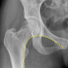 Helps to diagnose a neck of femur fracture 

line drawn from inferior border of the superior pubic ramus --> medial border of the femur neck