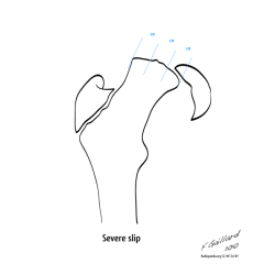 Helps to diagnose SUFE (slipped upper femoral epiphysis ) 

a straight line superior surface of the femoral neck should pass through the femoral head. 

If it remains superior/does not touch the femoral head/epiphysis --> trethowan's positive