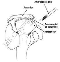 Unfused area of acromion 

Can lead to shoulder impingement