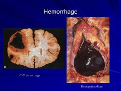o Hematoma: Accumulation of blood within a tissue

o Petechiae:  Hemorrhages that are small (1-2mm) often involving skin or mucus membranes.  Associated with decreased numbers of platelets, platelet dysfunction or less commonly, clotting fact...