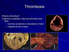 What is the difference between venous, arterial and mural thrombi.... what are complications of each?