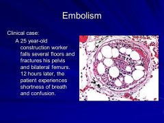 Thromboembolism: Pulmonary Embolus

- Venous thrombus (originating in the femoral vein most commonly) that potentially occludes small or large branches of pulmonary artery.

- Very common entity that occurs in a variety of clinical settings in...