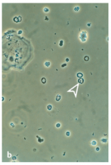 - dysmorpher Erythrozyt


- bläschenförmige Ausstülpungen der Zellmembran („Micky Mouse“).


- Die Verformung ensteht beim Durchtritt durch die glomeruläre Basalmembran und ist folglich beweisend für einen glomerulären Ursprung.