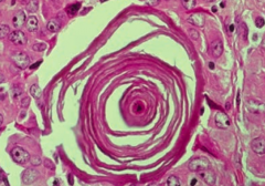 PSaMMoma bodies:
- Papillary carcinoma of thyroid
- Serous papillary cystadenocarcinoma of ovary
- Meningioma
- Malignant mesothelioma