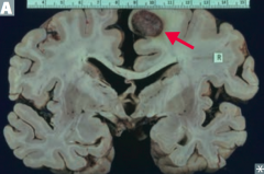 Multiple well-circumscribed tumors at gray/white matter junction