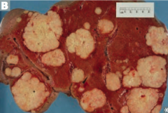 Liver and lung after the regional lymph nodes