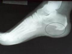 what is this? any problems associated with it? any relation to other injuries?