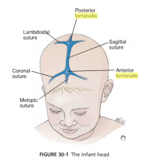 Head is normocephalic and symmetric. In newborns, the head may be oddly shaped from molding (overriding of the sutures) during vaginal birth. (713)
 
Bulging frontanell indicates increased cranial pressure. Microcephaly is seen in infants who have...