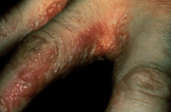 1.  Eruption on hands and sides of fingers (MC) or trunk in relation to systemic fungal antigens