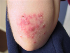 1.  Atypical tinea produced by treatment with topical steroid or calcineurin inhibitor