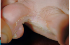 1.  E. floccosum, T. mentagrophytes
2.  Erythema and desquamation between the toes
