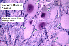 Tay-Sachs Disease:
- Enlarged ballooned neurons filled w/ PAS positive material (stored gangliosides)
- Storage also in other brain cells (astrocytes and microglia)