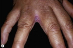 1.  Erythematous fissure between middle and ring fingers on hand
2.  Fourth interspace on feet
3.  Tx: dry, topical anticandidals