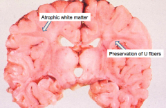 - Atrophic brain with firm white matter
- Atrophic white matter
- Preservation of "U" fibers