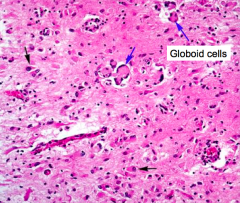 Presence of Globoid cells
- Loss of myelin
- Accumulation of globoid macrophages, cluster around vessels
- Severe astrocytosis
- Decreased numbers of oligodendrocytes
