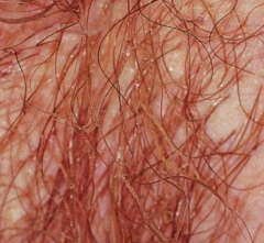 1.  MCC: T. cutaneum
2.  Yellow or beige-colored soft, slimy sheaths coating hair shafts