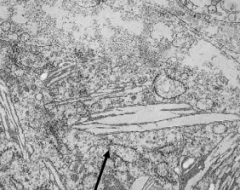 - Globoid Cells contain crystalloid STRAIGHT or tubular profiles
- Sign of Krabbe's Disease (Globoid Cell Leukodystrophy)
