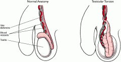 testicular  torsion