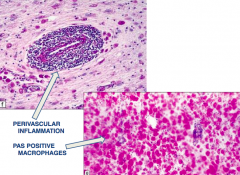 - Perivascular inflammation
- PAS positive macrophages